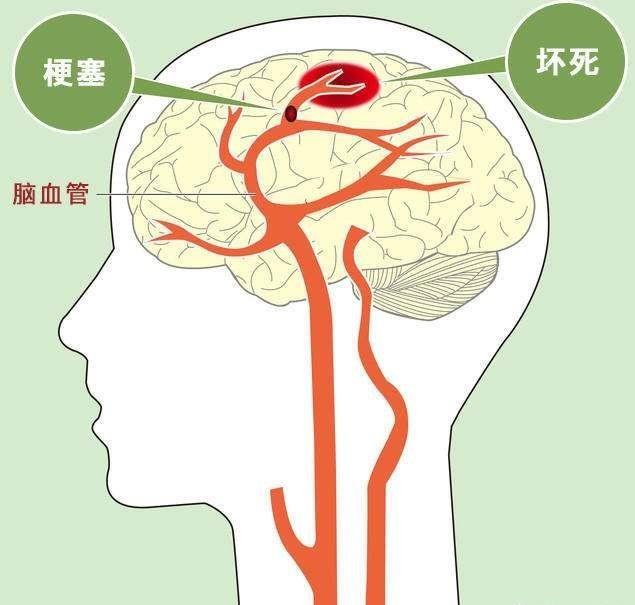 择思达斯：脑卒中都包括什么?